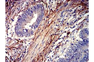 Immunohistochemical analysis of paraffin-embedded rectum cancer tissues using F2R mouse mAb with DAB staining.