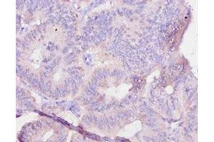 Immunohistochemistry of paraffin-embedded human colon cancer using ABIN7179323 at dilution of 1:10 (IL12B Antikörper  (AA 23-327))