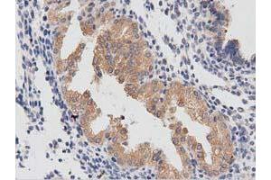 Immunohistochemical staining of paraffin-embedded Carcinoma of Human prostate tissue using anti-PTPRE mouse monoclonal antibody. (PTPRE Antikörper)