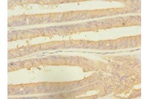 Immunohistochemistry of paraffin-embedded human endometrial cancer using ABIN7142540 at dilution of 1:100 (RPS27 Antikörper  (AA 1-84))