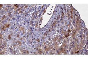 ABIN6276889 at 1/100 staining Human liver cancer tissue by IHC-P. (GABRA2 Antikörper  (N-Term))