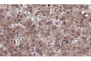 ABIN6273971 at 1/100 staining Human liver cancer tissue by IHC-P. (OR1J2/1N2 Antikörper)