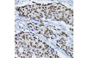 Immunohistochemistry of paraffin-embedded human colon carcinoma using S Rabbit pAb (ABIN7270154) at dilution of 1:100 (40x lens). (SATB2 Antikörper  (AA 540-620))