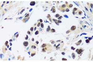 Immunohistochemistry of paraffin-embedded Human lung cancer using ASCL4 Polyclonal Antibody at dilution of 1:100 (40x lens).