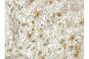 ABIN6257055 and ABIN6274988 at 1/100 staining human thyroid carcinoma by IHC-P. (CEP170 Antikörper  (Internal Region))