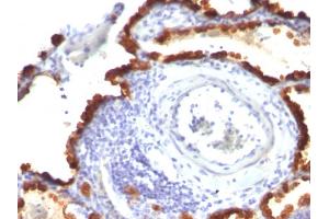Formalin-fixed, paraffin-embedded human Lung Ca stained with Cytokeratin 7 Mouse Monoclonal Antibody (KRT7/760 + KRT7/903). (Cytokeratin 7 Antikörper)