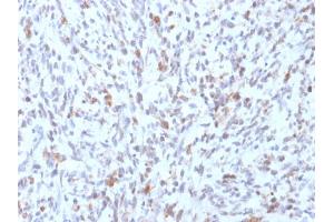 Formalin-fixed, paraffin-embedded human Rhabdomyosarcoma stained with MyoD1 Mouse Recombinant Monoclonal Antibody (rMYD712). (Rekombinanter MYOD1 Antikörper)