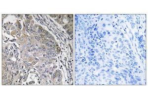Immunohistochemistry analysis of paraffin-embedded human lung carcinoma tissue using SPINK6 antibody. (SPINK6 Antikörper  (Internal Region))