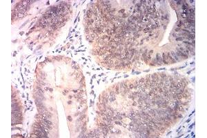 Immunohistochemical analysis of paraffin-embedded rectum cancer tissues using BRIP1 mouse mAb with DAB staining.