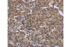 Immunohistochemistry of Human liver cancer using ETV7 Polyclonal Antibody at dilution of 1:30