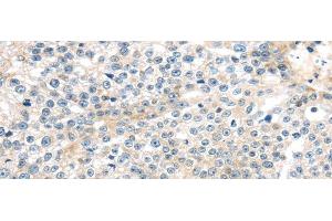 Immunohistochemistry of paraffin-embedded Human breast cancer tissue using TNFAIP8 Polyclonal Antibody at dilution 1:35 (TNFAIP8 Antikörper)