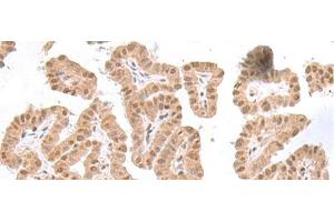 Immunohistochemistry of paraffin-embedded Human thyroid cancer tissue using TDP2 Polyclonal Antibody at dilution of 1:75(x200) (TDP2 Antikörper)