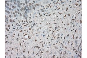Immunohistochemical staining of paraffin-embedded Adenocarcinoma of colon tissue using anti-BUB1Bmouse monoclonal antibody. (BUB1B Antikörper)
