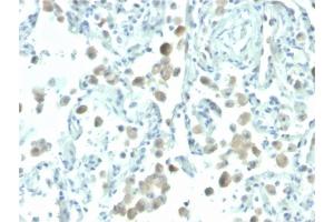 Formalin-fixed, paraffin-embedded human lung stained with Biotin-conjugated Mesothelin Mouse Monoclonal Antibody (MSLN/2131). (Mesothelin Antikörper  (AA 273-407) (Biotin))