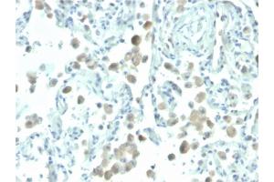 Formalin-fixed, paraffin-embedded human lung stained with Biotin-conjugated Mesothelin Mouse Monoclonal Antibody (MSLN/2131).