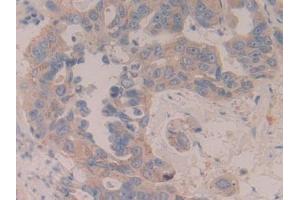 Detection of MAP2K6 in Human Breast cancer Tissue using Polyclonal Antibody to Mitogen Activated Protein Kinase Kinase 6 (MAP2K6) (MAP2K6 Antikörper  (AA 46-306))