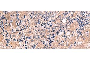 Immunohistochemistry of paraffin-embedded Human liver cancer tissue using INSM2 Polyclonal Antibody at dilution of 1:35(x200) (INSM2 Antikörper)