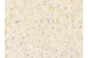 ABIN6258145 and ABIN6273917 at 1/100 staining human astrocytoma by IHC-P. (S1PR5 Antikörper  (C-Term))