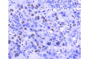 Paraformaldehyde-fixed, paraffin embedded Human lung, Antigen retrieval by boiling in sodium citrate buffer (pH6) for 15min, Block endogenous peroxidase by 3% hydrogen peroxide for 30 minutes, Blocking buffer at 37°C for 20min, Antibody incubation with Histone H2A. (H2AFZ Antikörper)