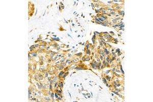 Immunohistochemistry of paraffin embedded human liver cancer using P4H (ABIN7074215) at dilution of 1:700 (400x lens) (HIF Prolyl Hydroxylase Antikörper)
