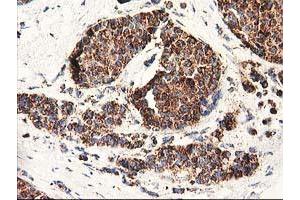 Immunohistochemical staining of paraffin-embedded Adenocarcinoma of Human breast tissue using anti-CLPP mouse monoclonal antibody. (CLPP Antikörper)