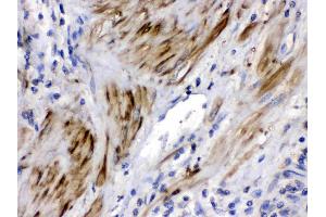 Cofilin 2 was detected in paraffin-embedded sections of human prostatic cancer tissues using rabbit anti- Cofilin 2 Antigen Affinity purified polyclonal antibody (Catalog # ) at 1 µg/mL.
