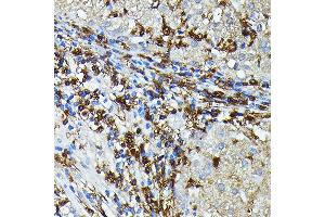 Immunohistochemistry of paraffin-embedded Human liver cancer using HLA-DPB1 antibody (ABIN7268370) at dilution of 1:100 (40x lens).