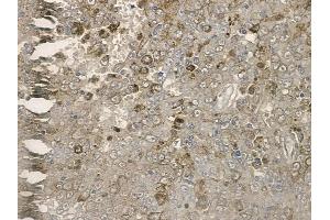 ABIN6255476 and ABIN6267169 at 1/100 staining human melanoma by IHC-P. (REPS1 Antikörper  (pSer709))