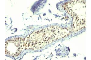 Formalin-fixed, paraffin-embedded human Testicular Carcinoma stained with Thymidylate Synthase Mouse Monoclonal Antibody (TS106). (TYMS Antikörper)