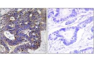 Immunohistochemistry analysis of paraffin-embedded human colon carcinoma tissue, using Collagen IV alpha2 Antibody. (COL4a2 Antikörper  (AA 151-200))