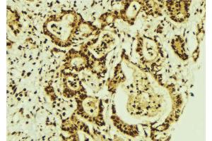 ABIN6274287 at 1/100 staining Human breast cancer tissue by IHC-P. (CEBPG Antikörper  (Internal Region))