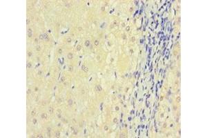 Immunohistochemistry of paraffin-embedded human liver cancer using ABIN7149702 at dilution of 1:100