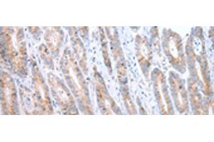 Immunohistochemistry of paraffin-embedded Human gastric cancer tissue using ATG16L1 Polyclonal Antibody at dilution of 1:40(x200) (ATG16L1 Antikörper)