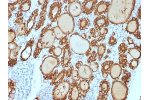 Formalin-fixed, paraffin-embedded human thyroid carcinoma stained with TPO Recombinant Rabbit Monoclonal Antibody (TPO/3813R). (Rekombinanter TPO (AA 685-804) Antikörper)