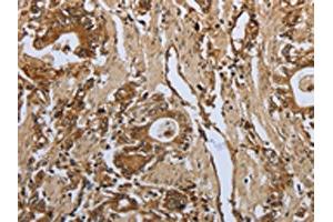The image on the left is immunohistochemistry of paraffin-embedded Human gastic cancer tissue using ABIN7191969(PPARA Antibody) at dilution 1/30, on the right is treated with synthetic peptide.