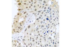 Immunohistochemistry of paraffin-embedded human lung cancer using DNAL1 antibody (ABIN5974658) at dilution of 1/100 (40x lens). (DNAL1 Antikörper)