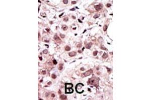 Formalin-fixed and paraffin-embedded human breast cancerreacted with AXL polyclonal antibody , which was peroxidase-conjugated to the secondary antibody, followed by AEC staining. (AXL Antikörper  (N-Term))