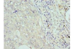 Immunohistochemistry of paraffin-embedded human lung cancer using ABIN7148039 at dilution of 1:100 (COCH Antikörper  (AA 20-260))