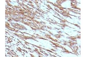Formalin-fixed, paraffin-embedded human leiomyosarcoma stained with pan Muscle Actin antibody (MSA/953) (Pan Muscle Actin Antikörper)