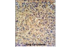 EXOC3L2 Antibody (N-term) (ABIN651216 and ABIN2840135) IHC analysis in formalin fixed and paraffin embedded human lung carcinoma followed by peroxidase conjugation of the secondary antibody and DAB staining.