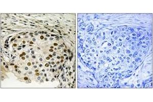 Immunohistochemistry analysis of paraffin-embedded human breast carcinoma, using OSR1 (Phospho-Thr185) Antibody. (OSR1 Antikörper  (pThr185))