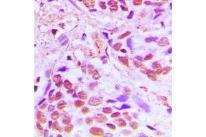 Immunohistochemical analysis of SRF staining in human breast cancer formalin fixed paraffin embedded tissue section. (SRF Antikörper  (Center))