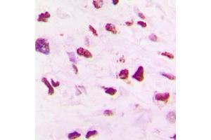 Immunohistochemical analysis of SKP2 staining in human lung cancer formalin fixed paraffin embedded tissue section. (SKP2 Antikörper  (C-Term))