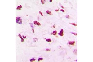 Immunohistochemical analysis of SKP2 staining in human lung cancer formalin fixed paraffin embedded tissue section.
