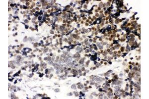 Anti-CTCF Picoband antibody, IHC(P) IHC(P): Human Lung Cancer Tissue (CTCF Antikörper  (AA 521-727))