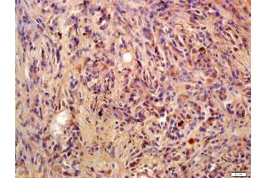 Formalin-fixed and paraffin embedded human lung carcinoma labeled with Anti-Phospho-BLNK(Tyr96) Polyclonal Antibody, Unconjugated (ABIN683458) at 1:200 followed by conjugation to the secondary antibody and DAB staining