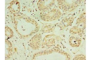 Immunohistochemistry of paraffin-embedded human breast cancer using ABIN7156912 at dilution of 1:100 (IL-37 Antikörper  (AA 1-218))