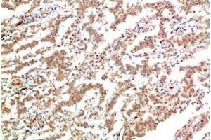 Immunohistochemistry of paraffin-embedded Human lung carcinoma tissue using JAK2 Monoclonal Antibody at dilution of 1:200. (JAK2 Antikörper)
