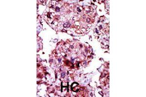 Formalin-fixed and paraffin-embedded human hepatocellular carcinoma tissue reacted with HK1 polyclonal antibody  , which was peroxidase-conjugated to the secondary antibody, followed by AEC staining. (Hexokinase 1 Antikörper  (N-Term))