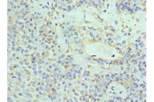 Immunohistochemistry of paraffin-embedded human breast cancer using ABIN7161741 at dilution of 1:100 (NTRK3 Antikörper  (AA 40-300))